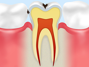 C1（エナメル質虫歯）