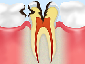 C3（歯髄虫歯）