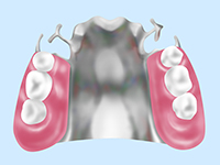 自費の入れ歯
