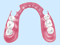 ノンクラスプ入れ歯