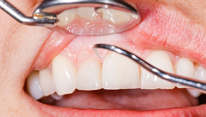 歯の喪失原因第一位の歯周病に対する取り組み