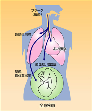 歯周病と全身疾患