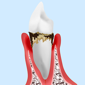 重度歯周炎