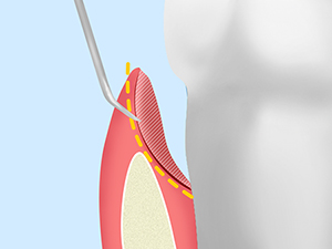 歯周ポケットそうは術