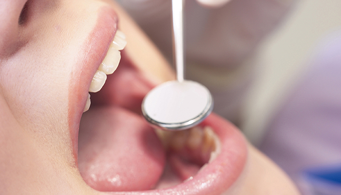 虫歯や歯周病を予防する